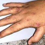 Permethrin original Soap-Prevention of Scabies (India)-75g